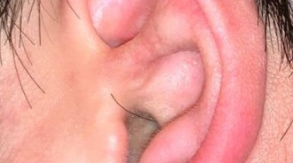 耳朵出現「小強觸角」男子嚇壞 趕緊掛急診！醫生一看傻住了