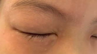 寫數學就過敏！9歲女孩「眼睛腫到睜不開」，過來人分析原因