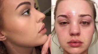 正妹以為眼睛上面的只是普通痘痘，擠掉後她卻「差點眼瞎」嚇到警告大家不要學她