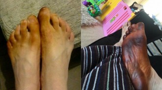 一起床發現腳異常反黑，以為得了怪病...得知「病因」差點受不了!!!
