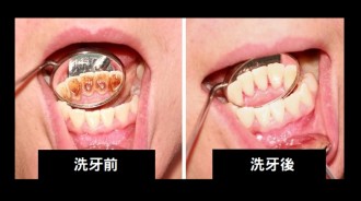 洗牙後齒縫變很大還很酸.....搞懂洗牙迷思！